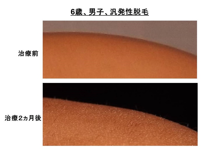 円形脱毛症　病院""